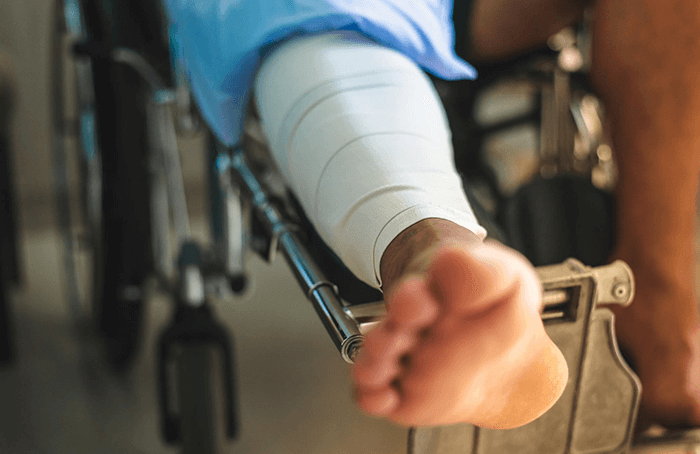 Tratamiento de fracturas con reducción cerrada